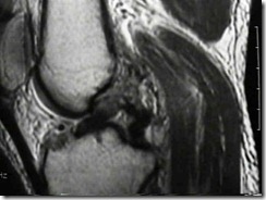 knee dislocation mri